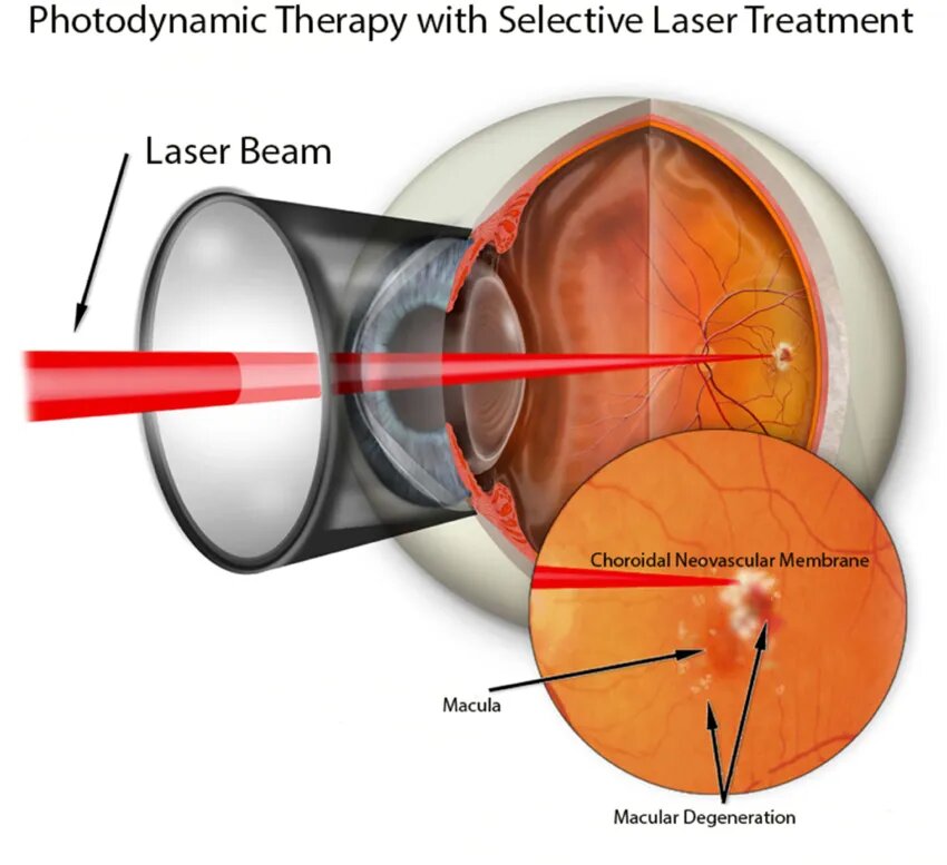Graphic-depiction-of-light-focused-on-a-choroidal-neovascular-membrane-in-the-application